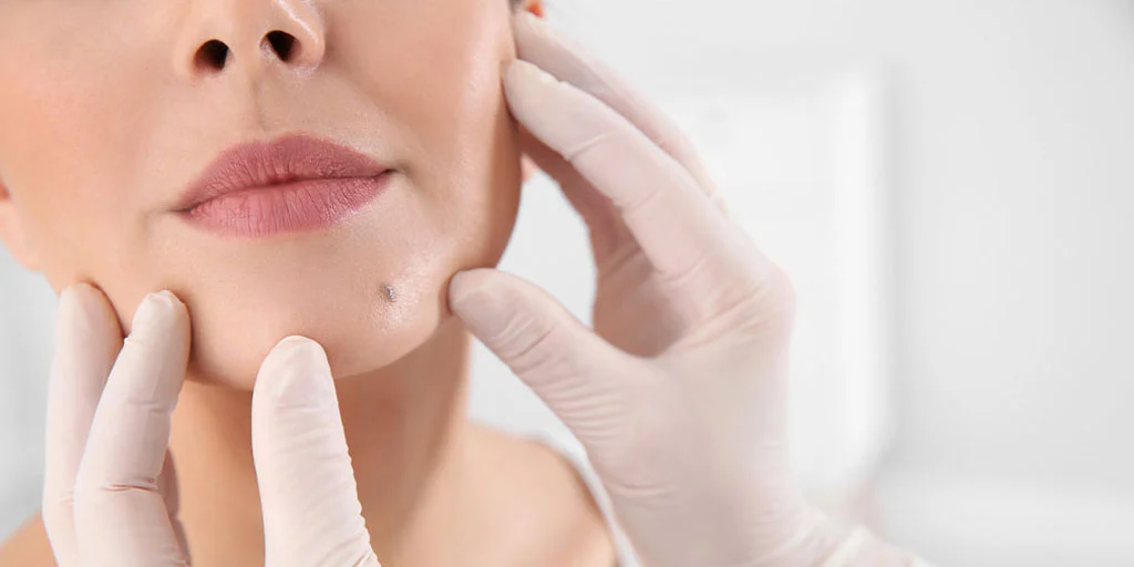 Mole Removal in Pune 1