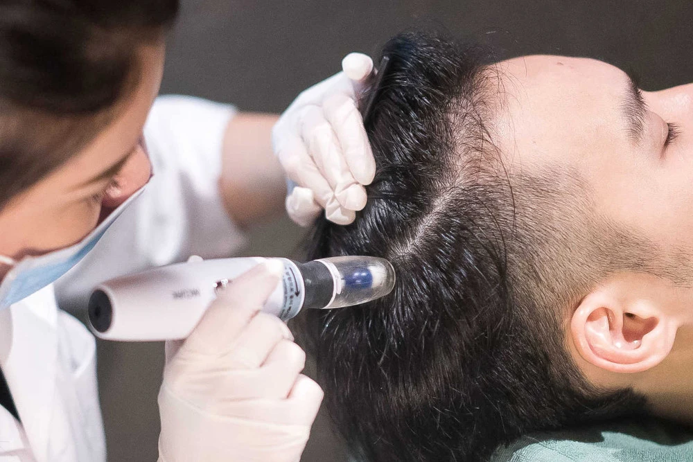 mesotherapy-for-hair-in-Pune