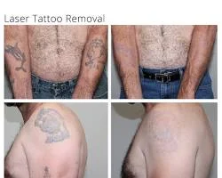 Tattoo Removal