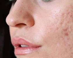 Acne Scars on Skin