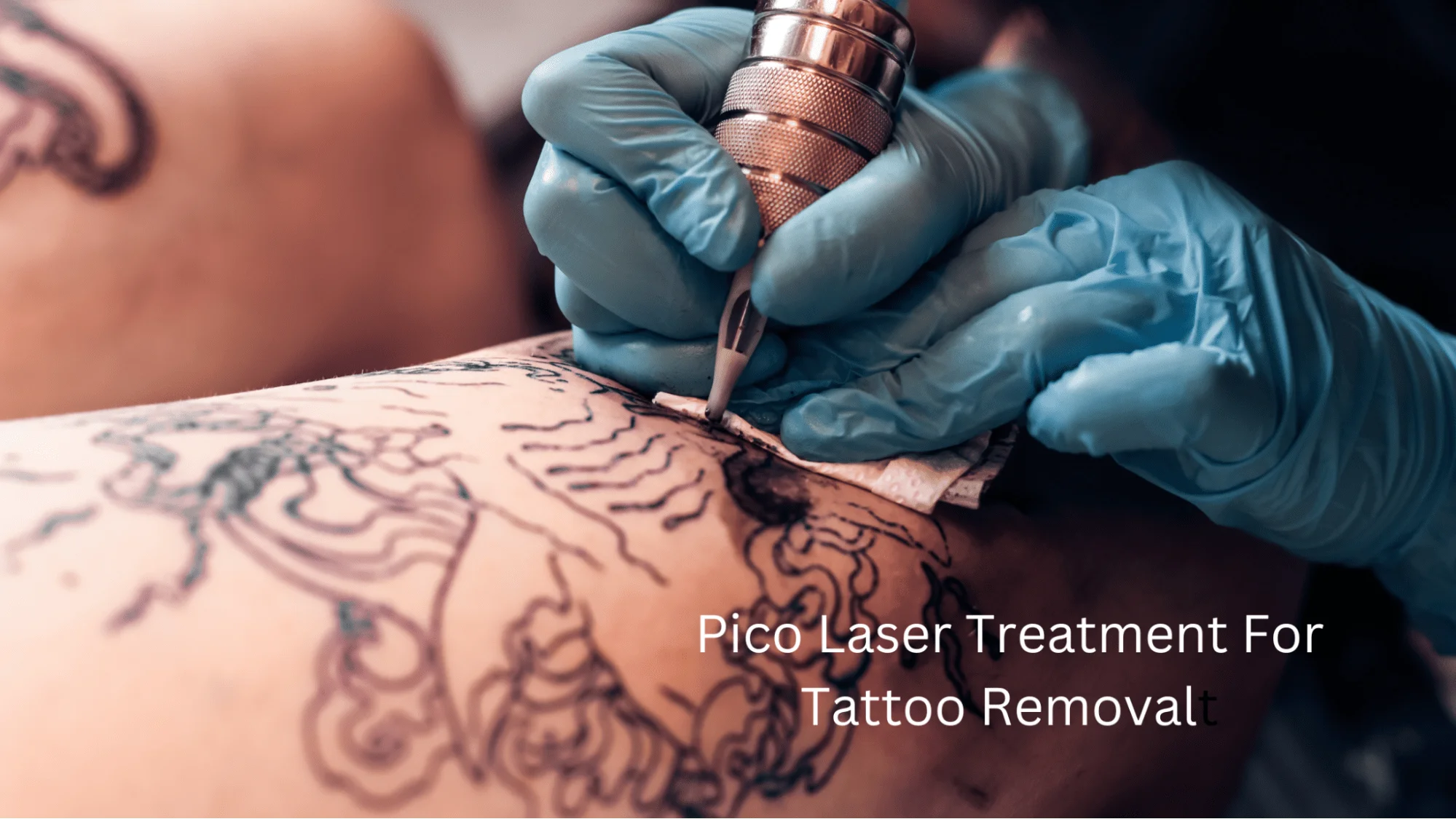 Why Pico Laser Technology is a Game-Changer in Laser Treatments?