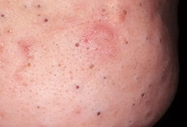 Image showcasing blackheads- type of acne