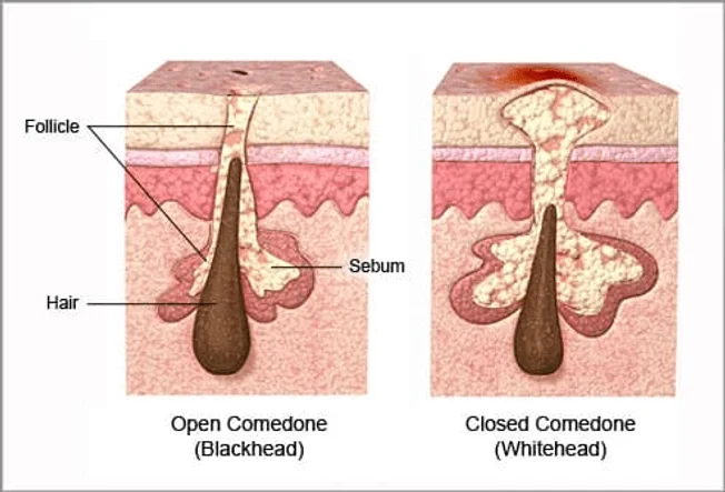 Image which shows blackheads and whiteheads type of acne what they look like