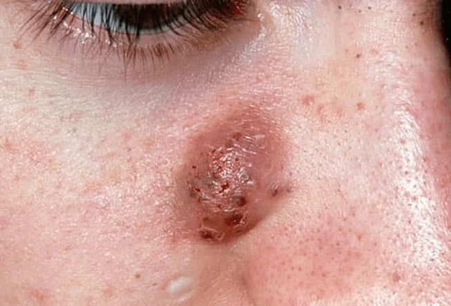 Inflammatory acne- cysts-type of acne