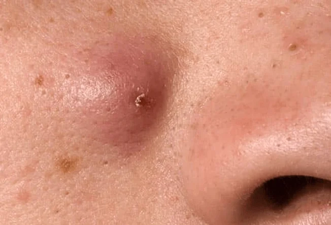 Inflammatory acne- nodules- type of acne