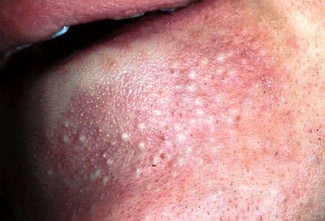 Inflammatory acne- pappules