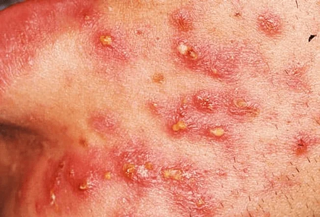 Inflammatory acne- pustules- type of acne