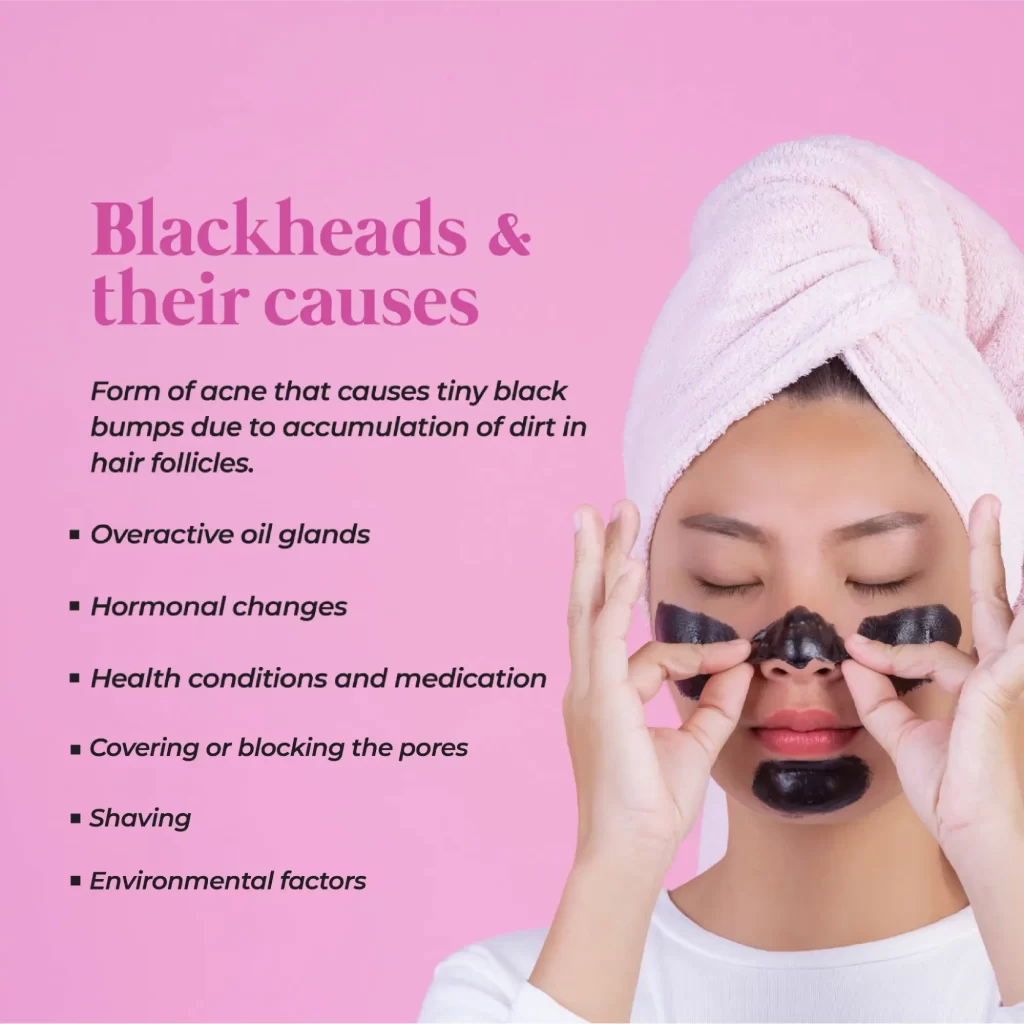 Infographic that shows different causes of blackheads