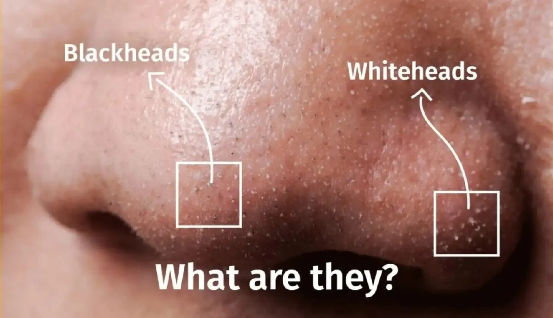 image showing blackheads and whiteheads type of acne