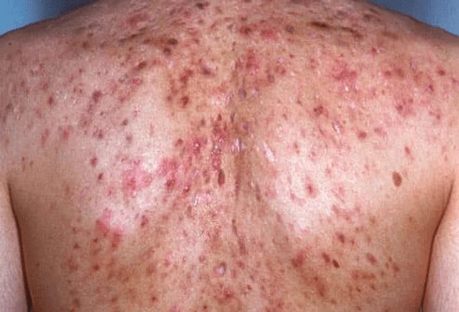 severe acne on the back