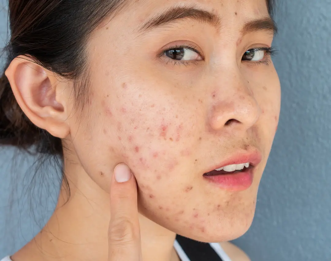 Lost Confidence to Nodular Acne Here’s the Ultimate Guide to Getting Clear Skin (and Your Life) Back - blog featured image