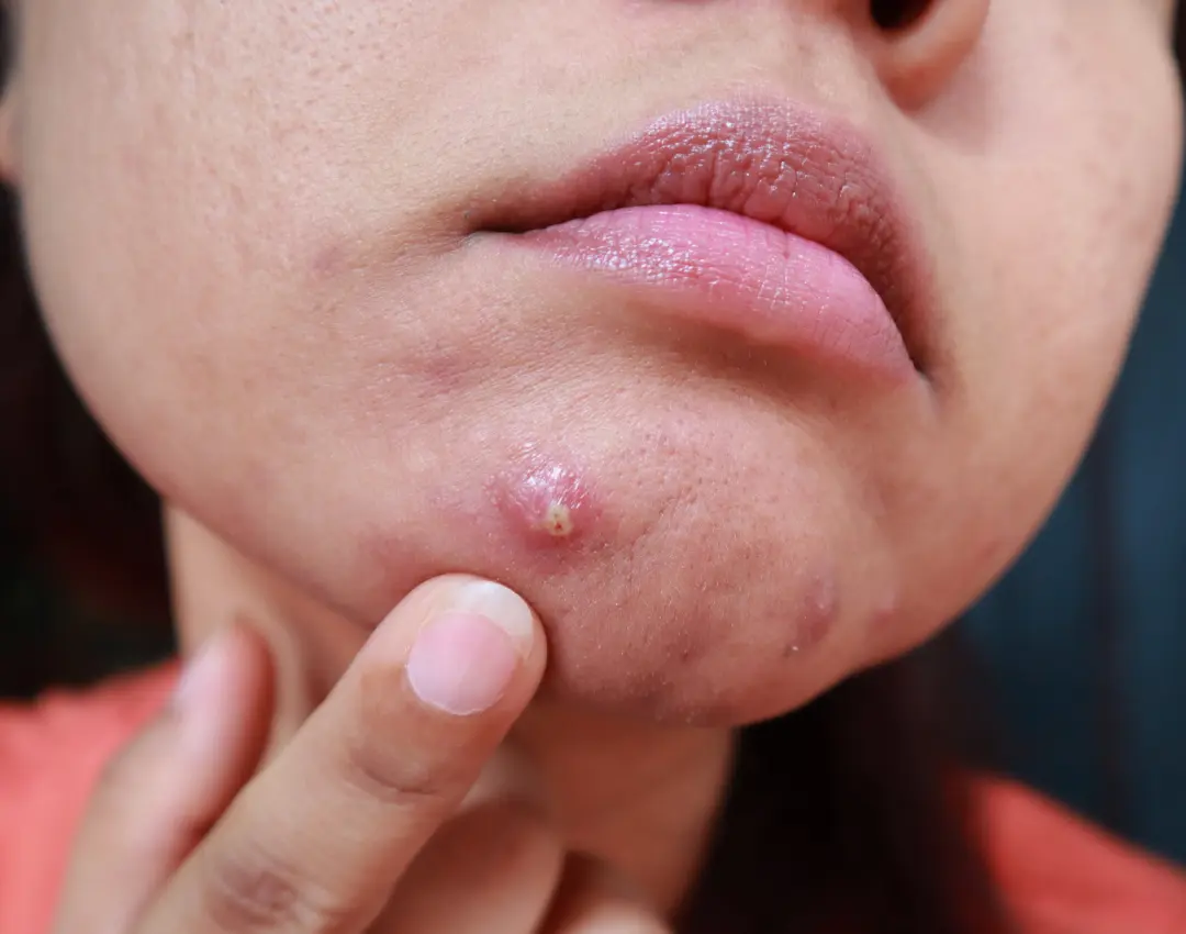 Struggling with Cystic Acne Here’s Everything You Need to Know to Fight Back- featured image