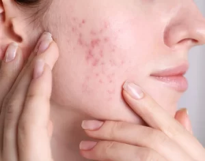 Hormonal Acne How to Balance Your Skin During Hormonal Changes- fetaured image