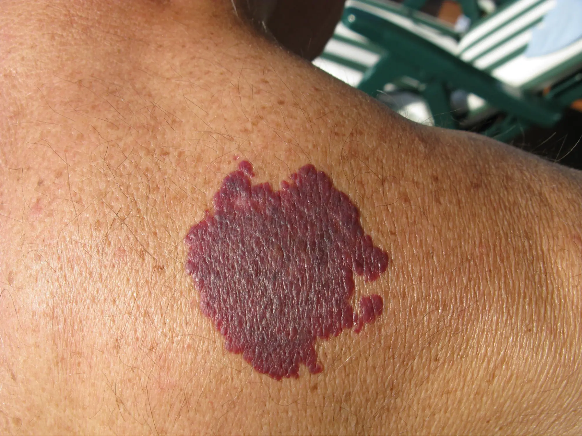 BirthMark Removal Treatment in Pimpri Chinchwad