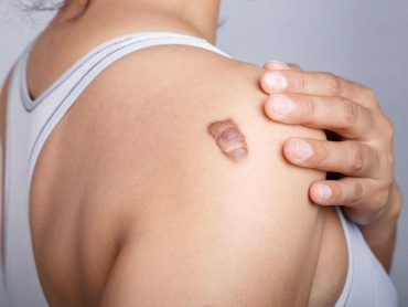 Keloid Removal Treatment in Pune