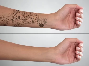 Tattoo Removal in Pune